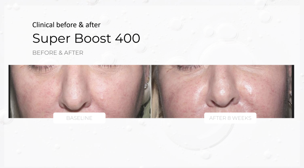 Super Boost 400 – product details, medical-grade skincare by Zahav Medspa